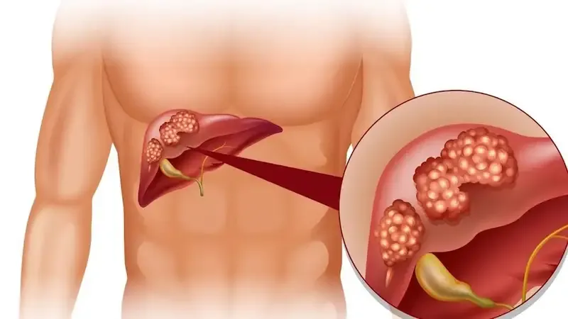 Chẩn đoán bệnh viêm gan A 1