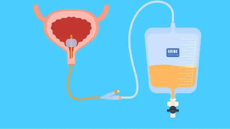 Phương pháp điều trị bệnh viêm niệu đạo do lậu 1