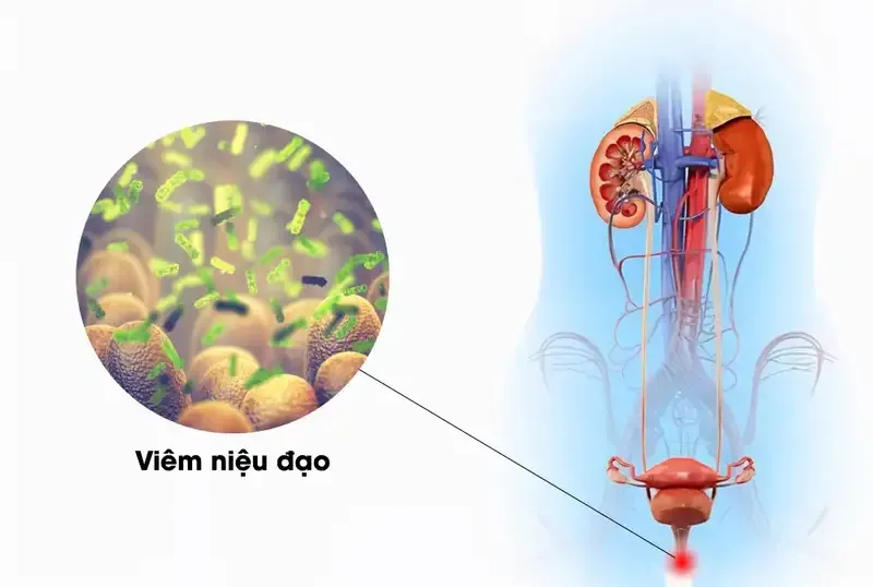 Nguyên nhân gây bệnh viêm niệu đạo không do lậu 2