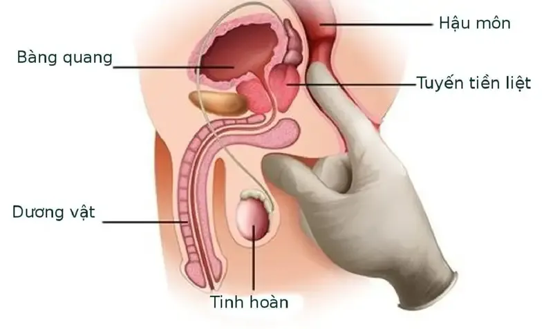 Chẩn đoán bệnh viêm niệu đạo không do lậu 1