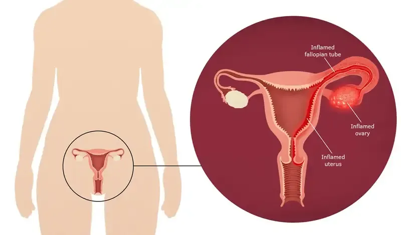 Chẩn đoán bệnh viêm vùng chậu