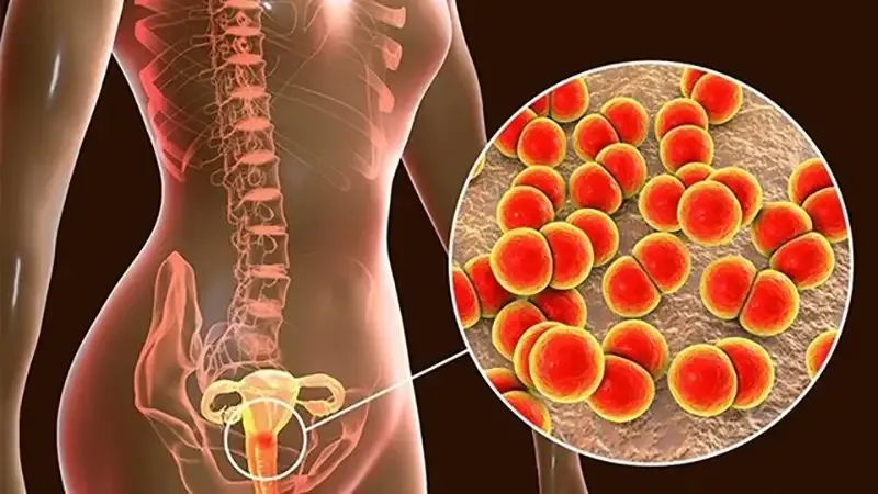 Điều trị bệnh viêm vùng chậu 2