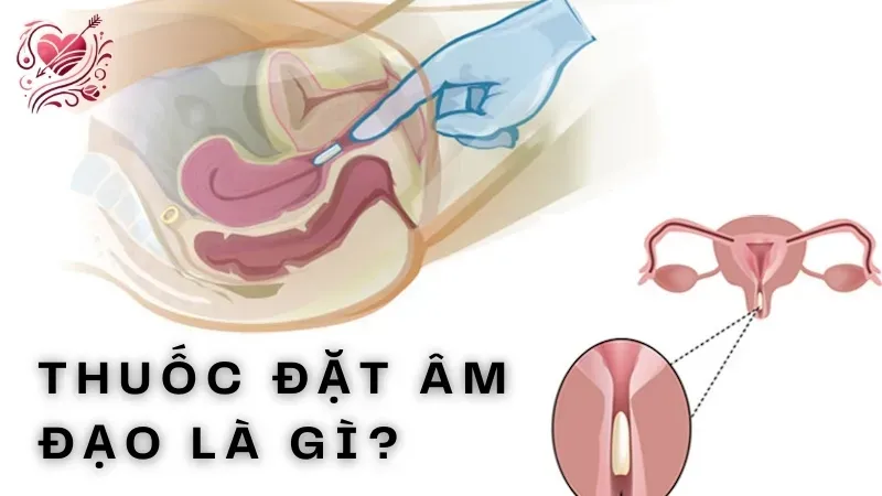 Thuốc đặt âm đạo là gì?