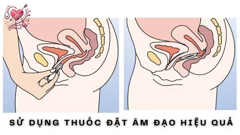 Sử dụng thuốc đặt âm đạo hiệu quả