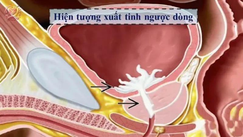 Xuất tinh ngược dòng có nguy hiểm không?