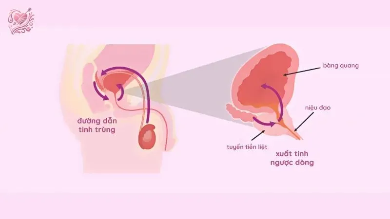 Phương pháp phòng ngừa xuất tinh ngược dòng ở nam giới