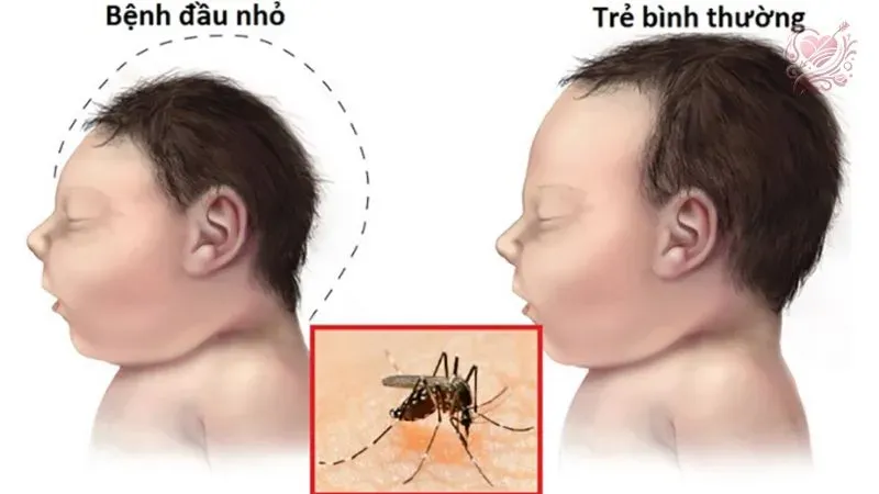 Triệu chứng của virus Zika