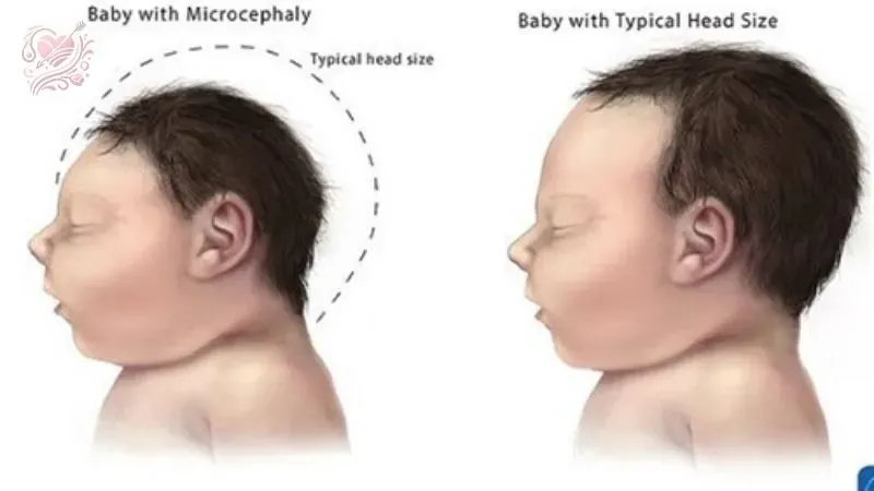 Phụ nữ mang thai mắc bệnh virus Zika nguy hiểm thế nào?
