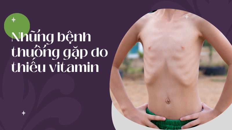 Trẻ em bị còi xương suy dinh dưỡng do thiếu vitamin d trầm trọng