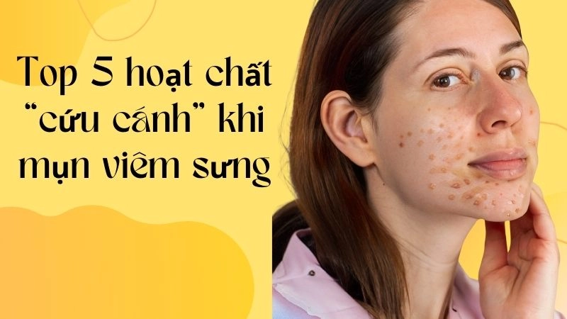 Top 5 hoạt chất “cứu cánh” khi mụn viêm sưng to đùng