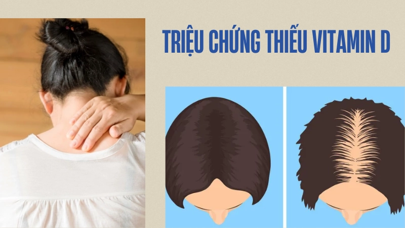 Dấu hiệu cảnh báo cơ thể thiếu vitamin D