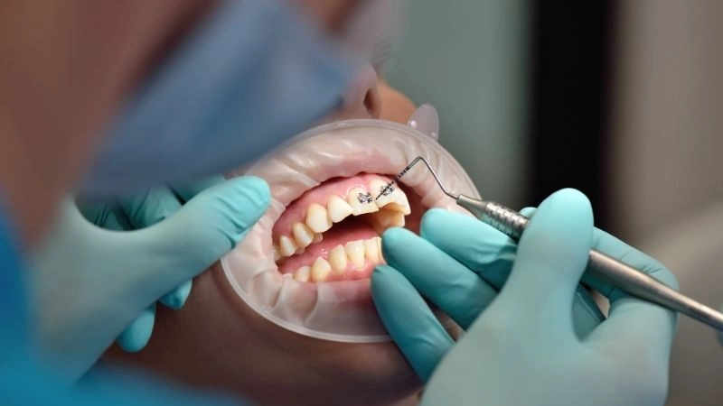 Giai đoạn điều chỉnh và dàn đều răng